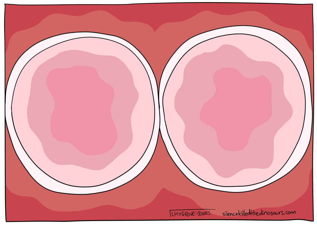 Two empty amniotic sacs.